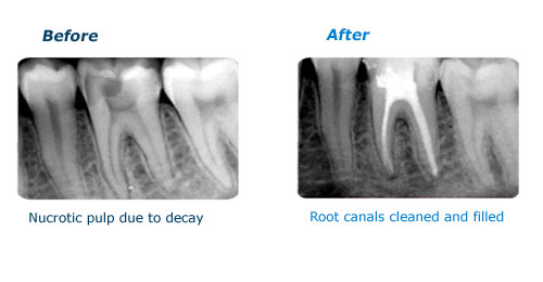 Before and After Picture of Root Canal