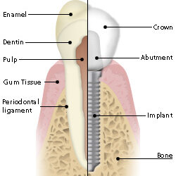 Picture of Dental Implant