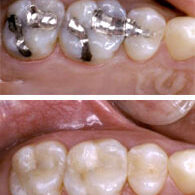 Picture of White Dental Filling
