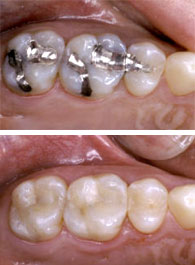 Picture of White Dental Filling