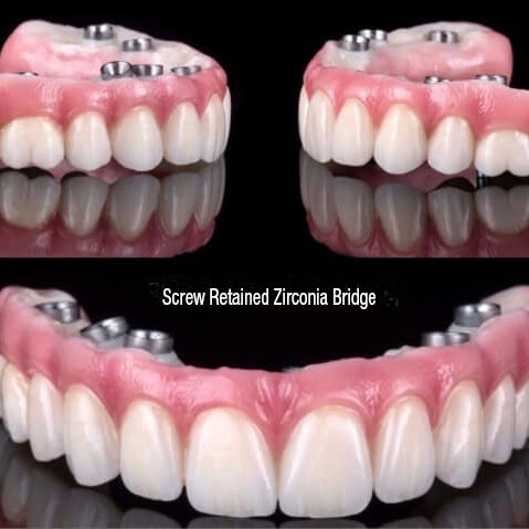 Fixed Implant Dentures and Bridges