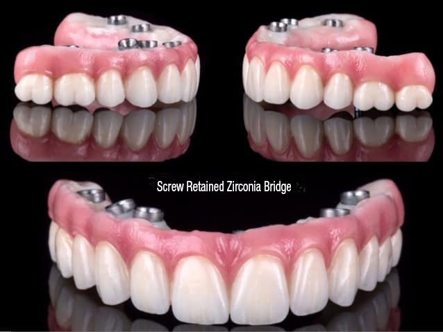 Fixed Implant Dentures and Bridges