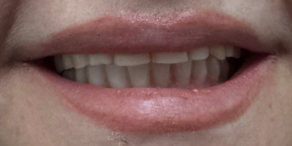 Picture of an After Dental Implant