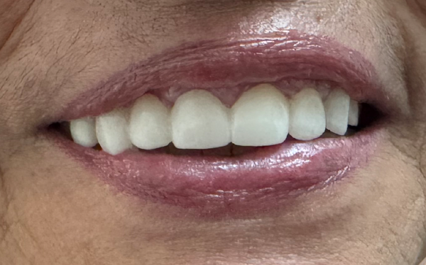 Picture of After Prosthetic Implant