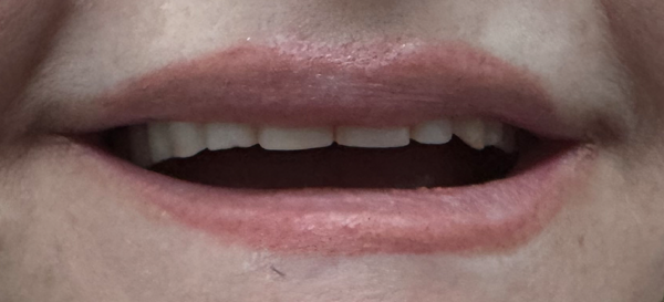 Before Dental Implant