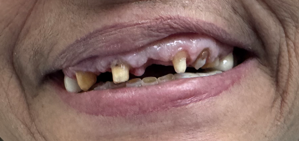 Picture of Before Dental Implant
